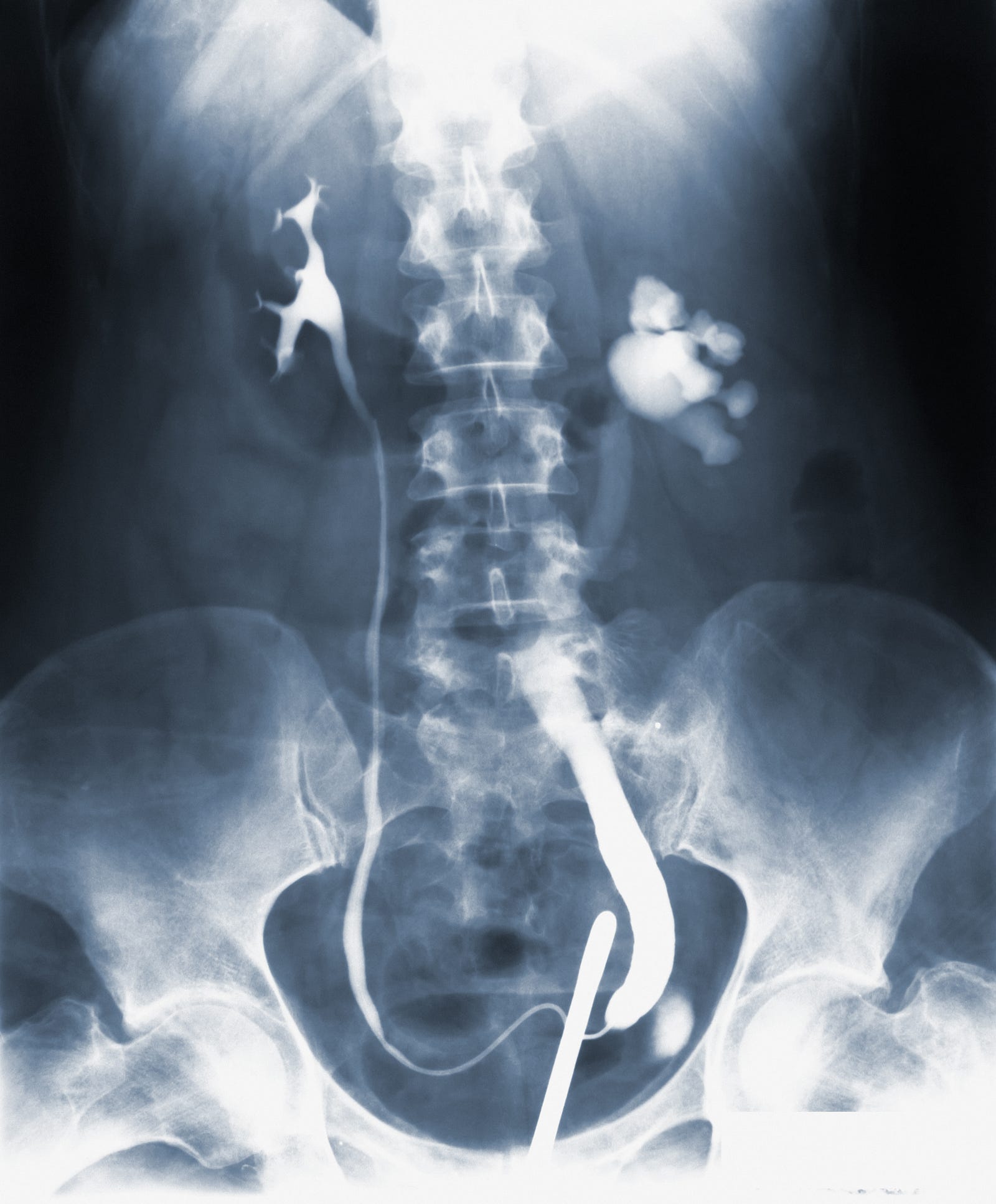 An X-ray image of the abdomen and pelvis, with contrast material flowing from the kidneys and down the ereters into the pelvis. Imagine your kidneys like a trusty water purifier in your house. They constantly filter your blood, removing waste and extra fluids like unwanted guests in your system.