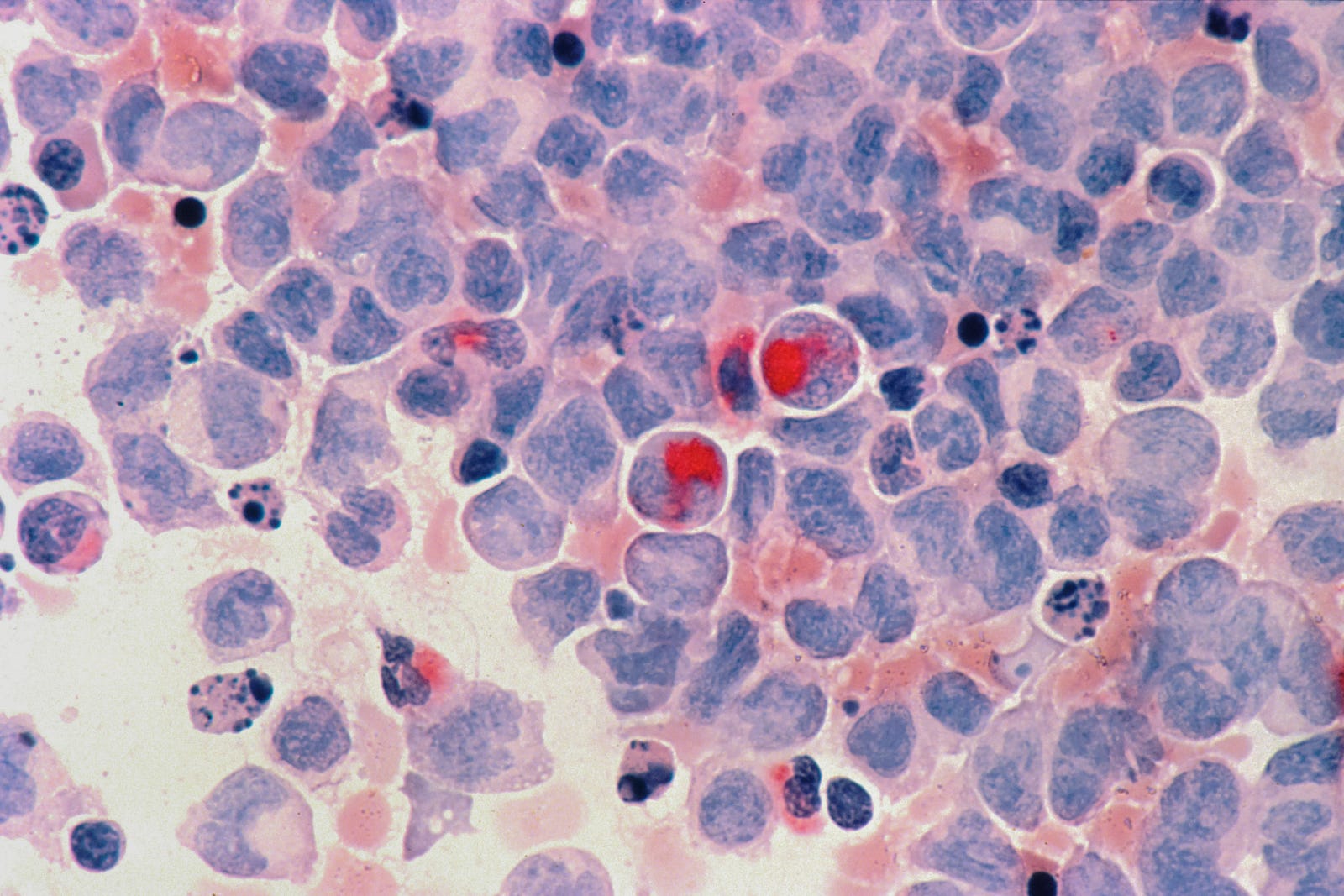 Photomicrograph of breast cancer cells. By leveraging AI, we can delve deeper into the mysteries of cancer, uncovering hidden patterns and gaining a more comprehensive understanding of its underlying mechanisms.