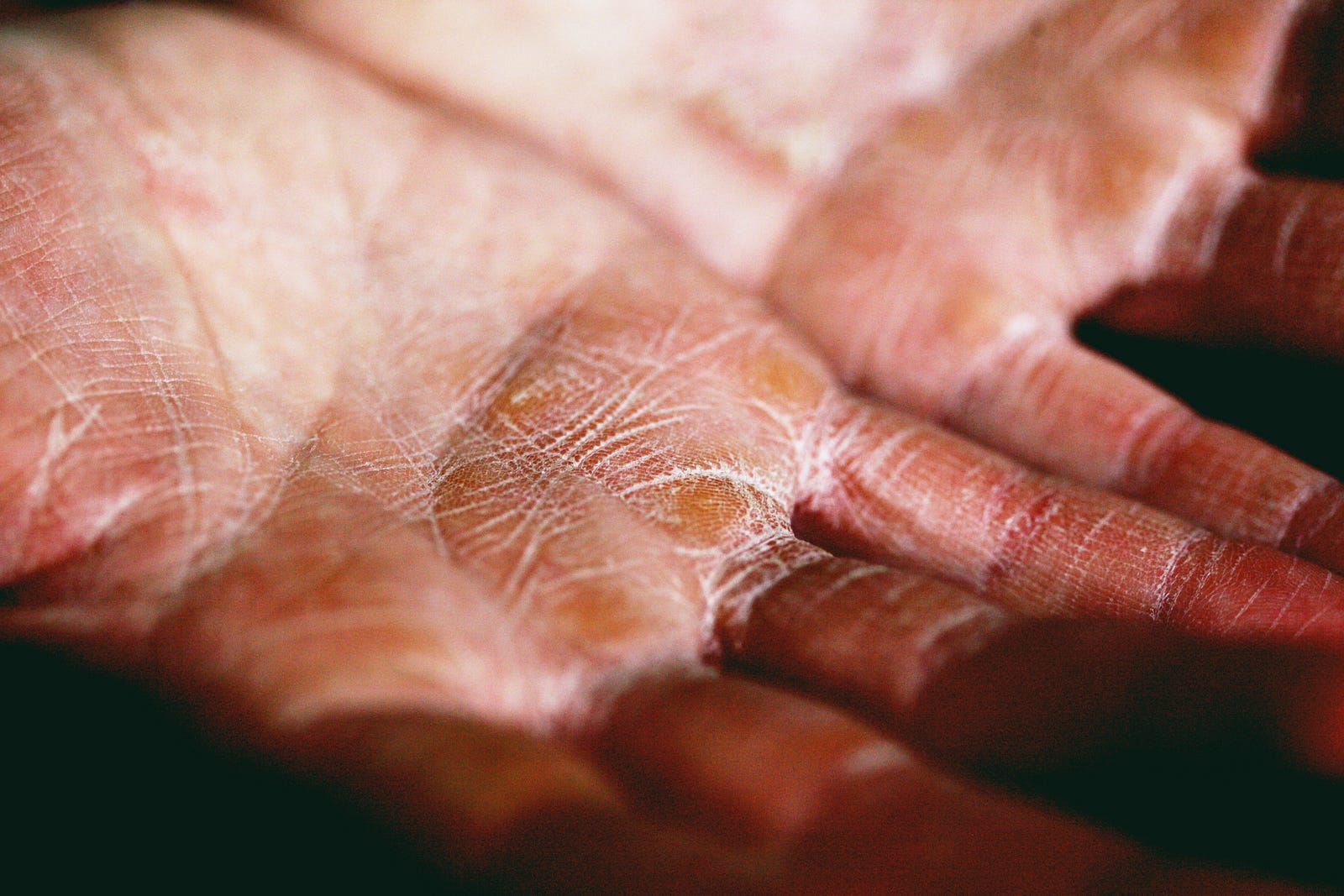We see the palms of an individuals, scaliness consistent with eczema. While particulate matter from smoke can penetrate the skin, there may also be an overactive immune response to the air pollution, resulting in flares of skin issues such as eczema.