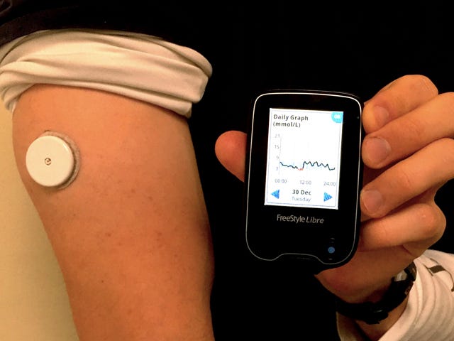 Continuous Glucose Monitoring — The First Four Weeks