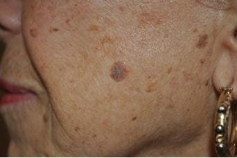 What Is Seborrheic Keratosis Removal Home Treatment