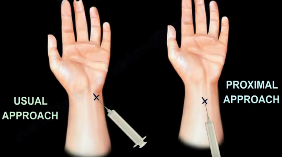 Carpal Tunnel Injection Technique And Overview The Pr - vrogue.co