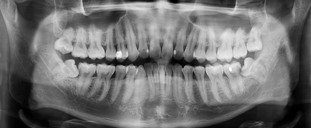 Kenapa gigi bongsu selalu buat hal – Dr Rezzuan Rahim – Medium