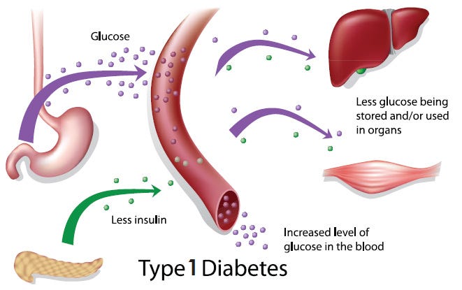 About Type 1 Diabetes You Need to Know – along karma – Medium