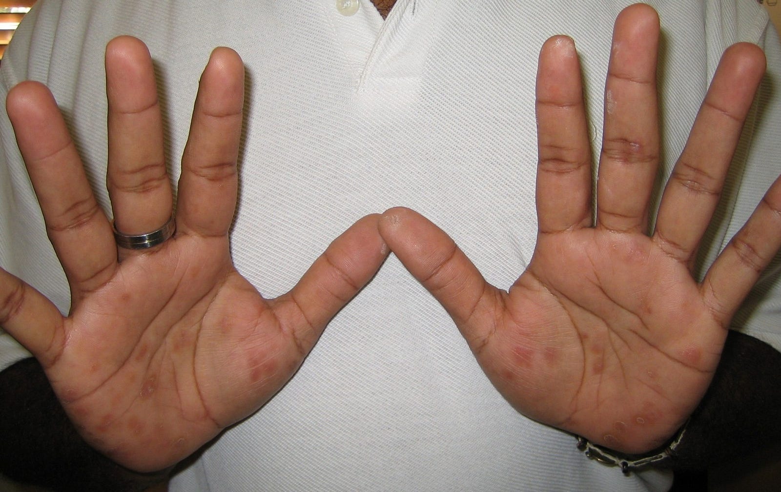 Syphilis: işaretler Syphilis: işaretler