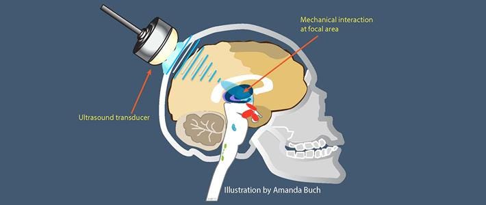 Transcranial Focused Ultrasound