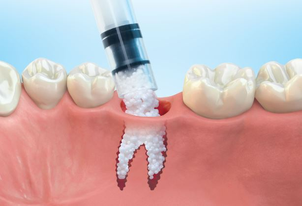 The Patient's Guide To Bone Graft - Zentist