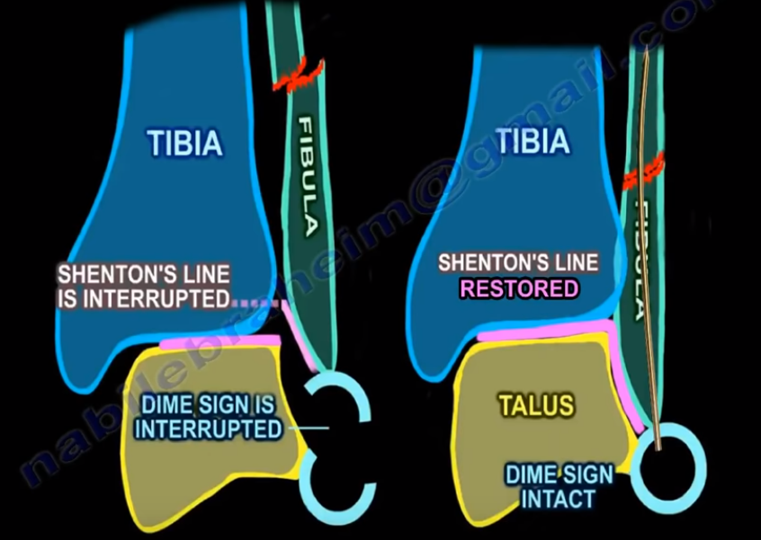 Ankle Fractures – Nabil Ebraheim – Medium