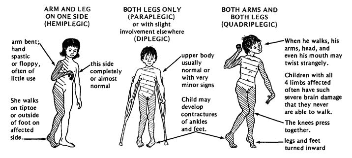 spastic-paralysis-suggests-involvement-of-the-difference-between