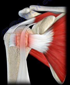 Tendon Ruptures Around the Shoulder – Nabil Ebraheim – Medium