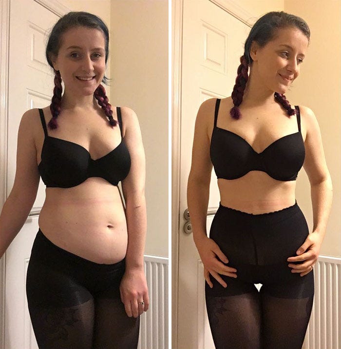barriga flacida despues de adelgazar rapido