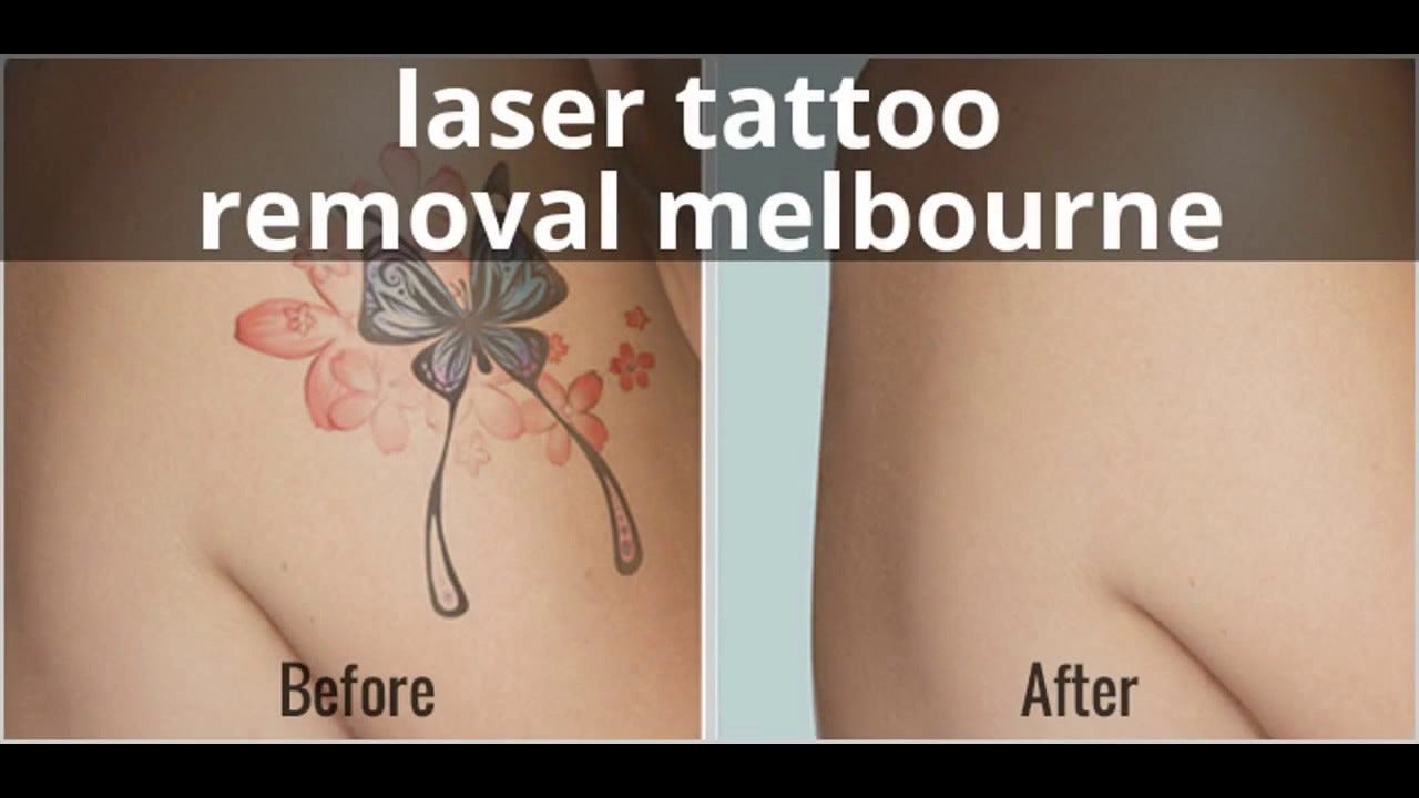 Tattoo Removal Cost Melbourne - Can Tattoos Be Removed Completely Does Laser Removal For ... - Check spelling or type a new query.