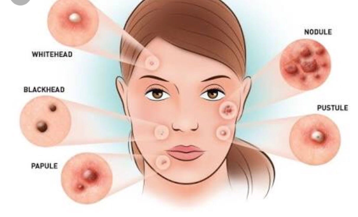 An Overview of Acne recommendations An Overview of Acne advise