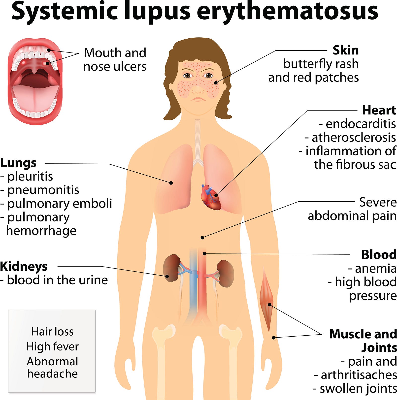 Lupus Risks Rates And Mobilization Of The Invisible Disease