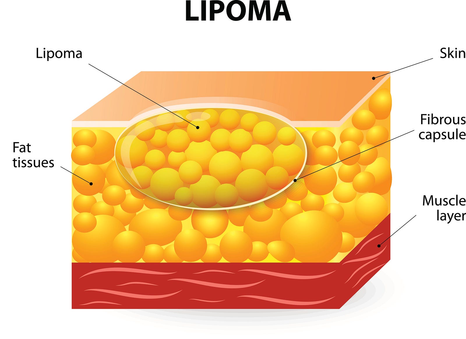 Comment Se Forme Un Lipome - Image to u