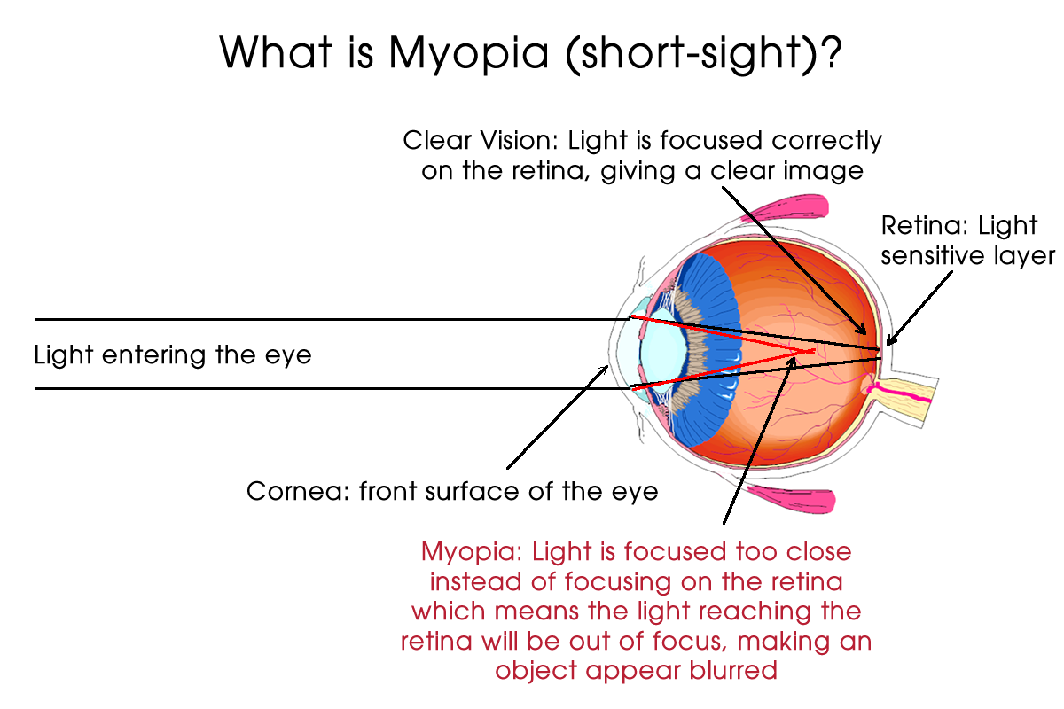 What Is Myopia Short Sight My Kid s Vision Medium