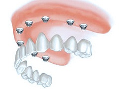 Full dental implants near me