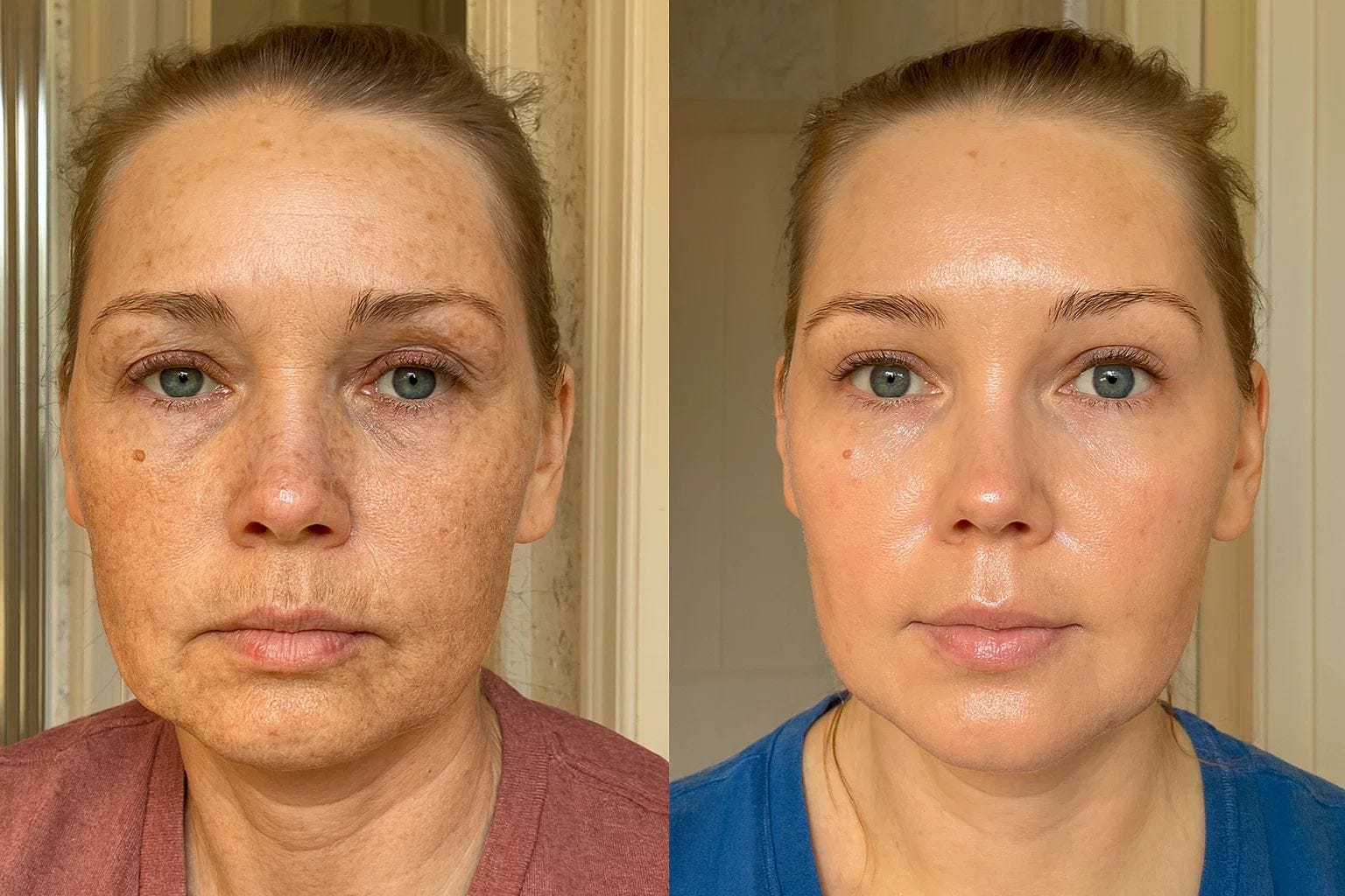Tretinoin-Based Skincare for Clearer, Smoother Skin: How OKDERMO Brings Acne Care and Anti-Wrinkle Routines Together