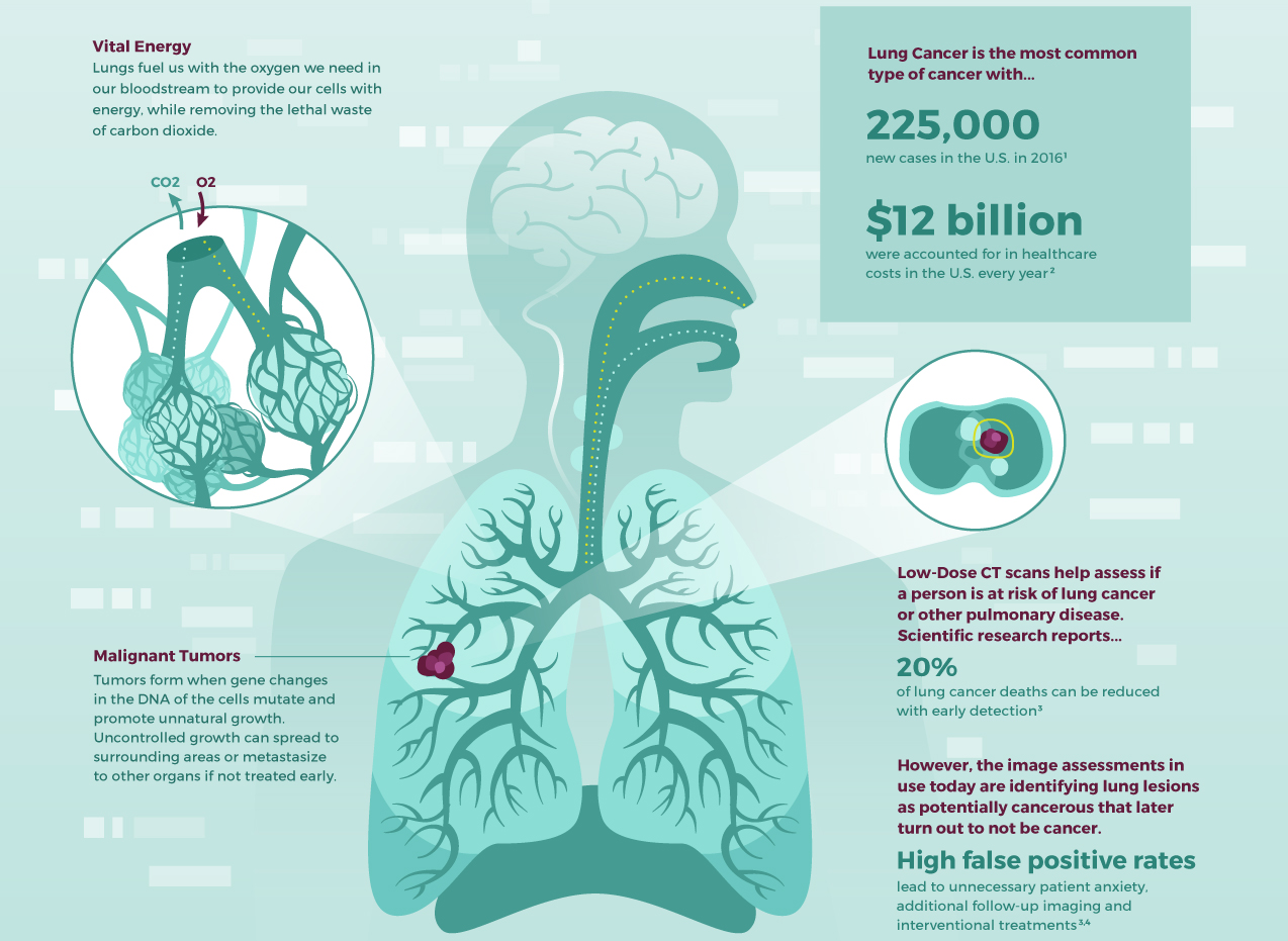 Nodulee Overview : Detecting early stage lung cancer