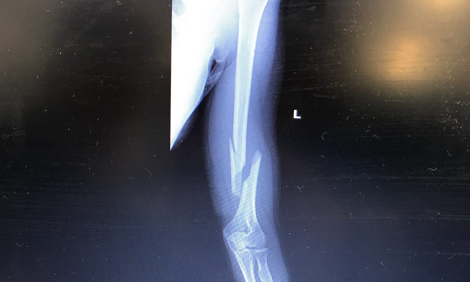 A Broken Humerus — Road to Recovery Maddie Wirthman Medium