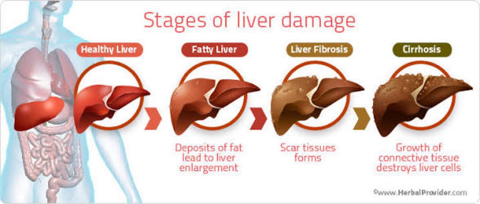 Fatty Liver Thanrada Yawichai Medium