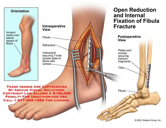 Broken fibula diagram tibia fibula diagram broken fibula diagram tibia fibula diagram
