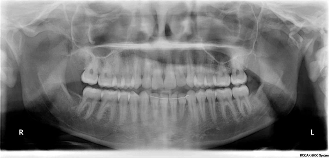 break f line to Nord Break Medium Un â€“ â€“ How Jaw Claire Your