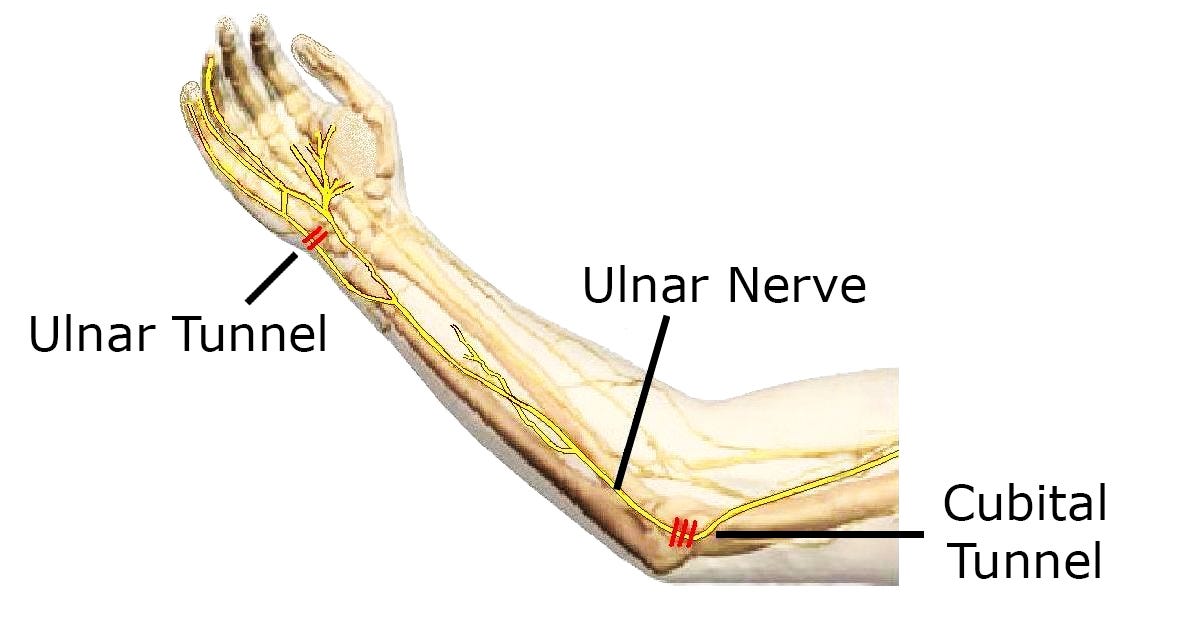 Not Carpal It’s The Other Tunnel Syndrome Chad Clabo