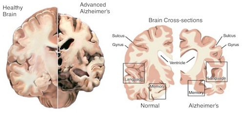 The Tale of Inflammation, Microglia, and Alzheimer’s