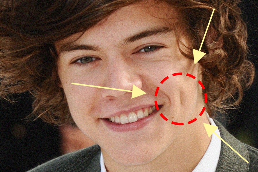 Millennials Are Heading to the Plastic Surgeon for Harry Styles-esque ...