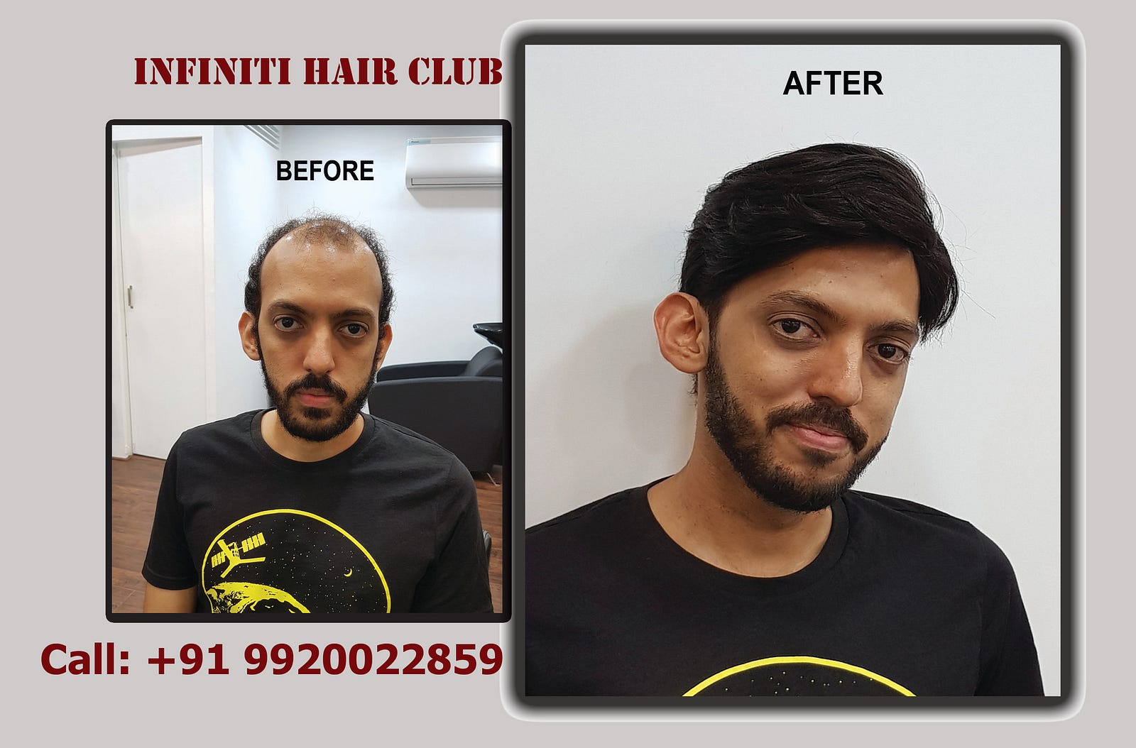 Non Surgical Hair Replacement Process Infiniti Hair Club