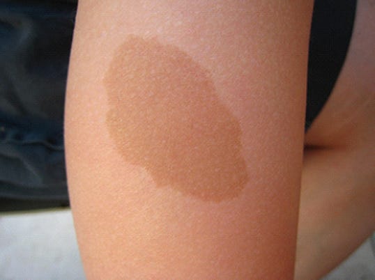 This Is What The Position Of Your Birthmark Reveals About You