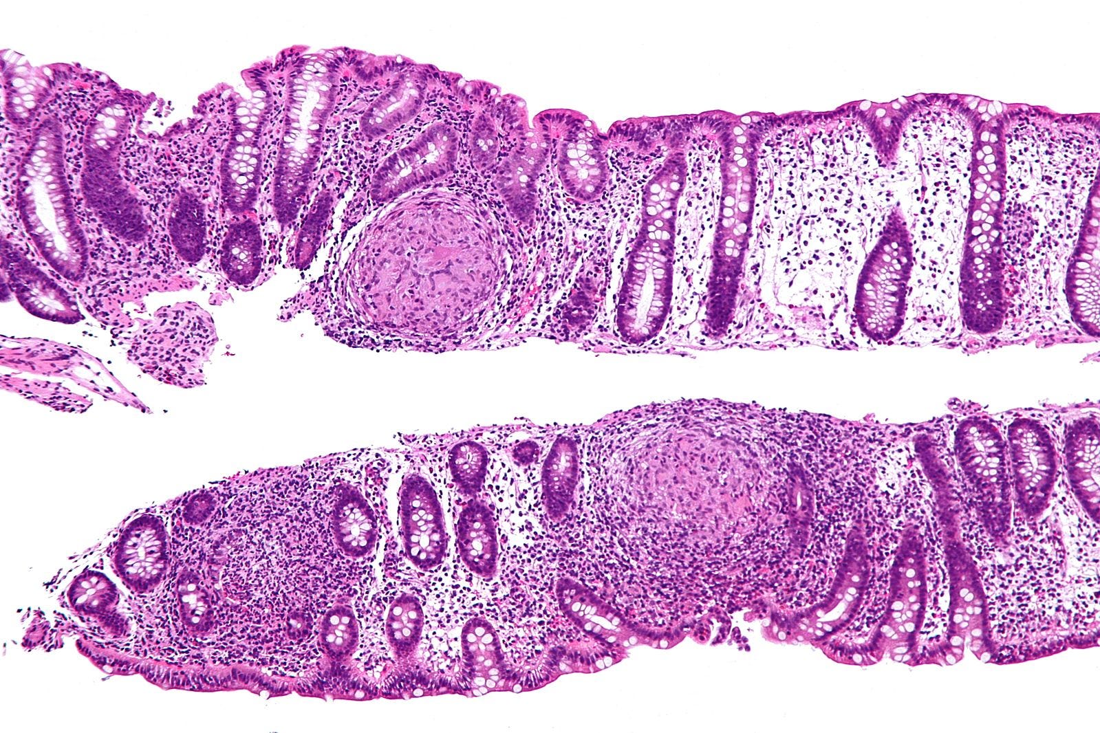 Understanding IBD Crohn’s Disease and C. diff Caroline