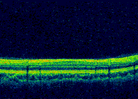 Machine Learning and OCT Images — the Future of Ophthalmology