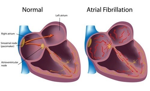 What Does Atrial Fibrillation Look Like