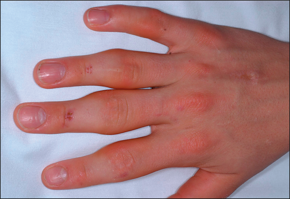 Finger Joint Pain And Swelling