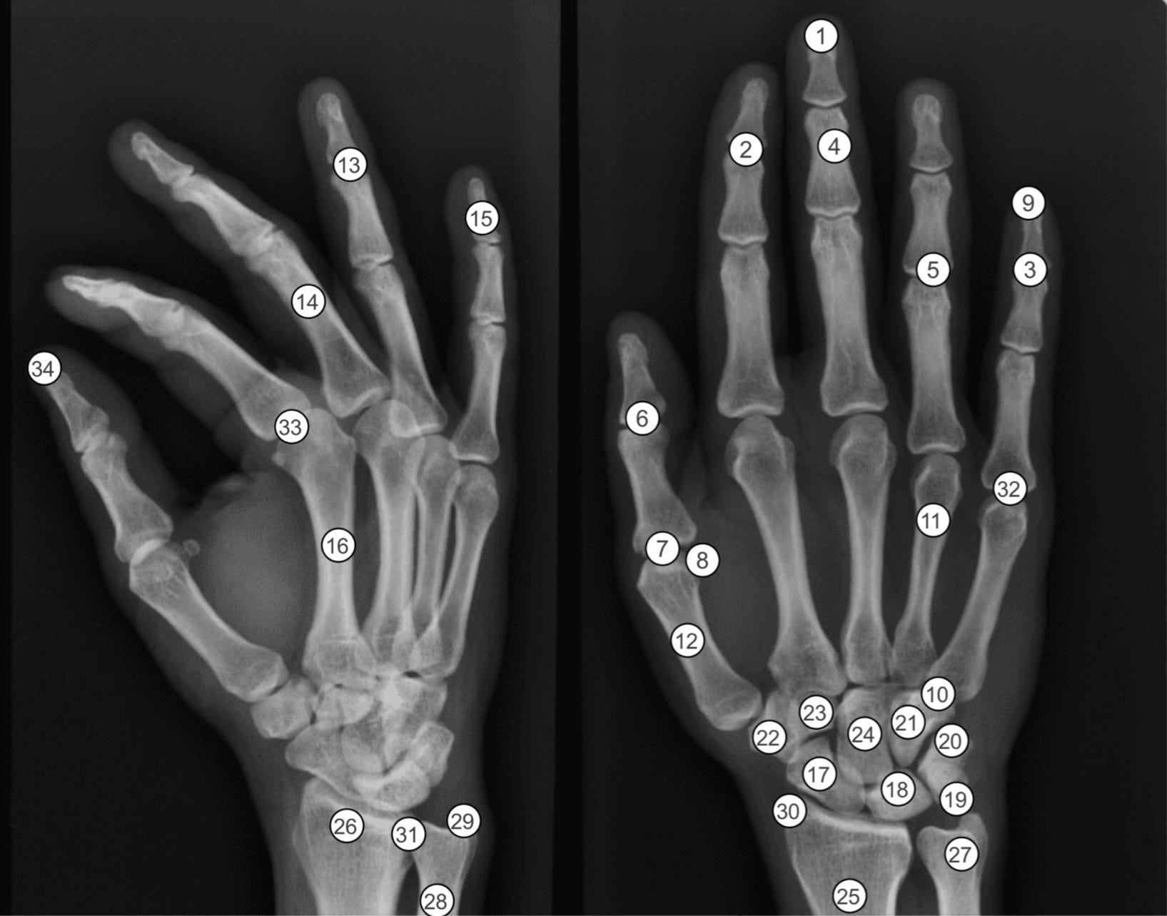 Analysis of Hand X-Ray Interpretation: GPT-4o v/s an Medical Expert