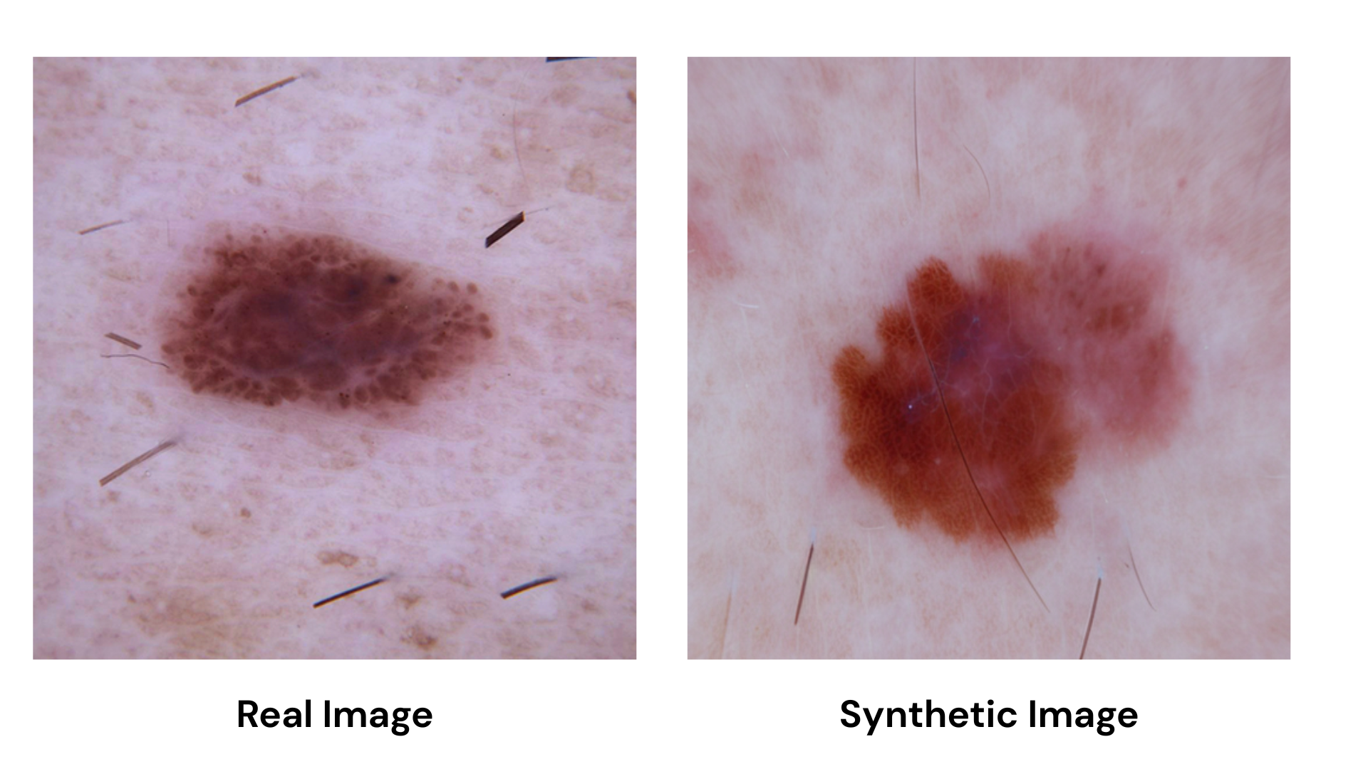 Can AI-Generated Skin Lesion Images Actually Help Detect Skin Cancer Better?