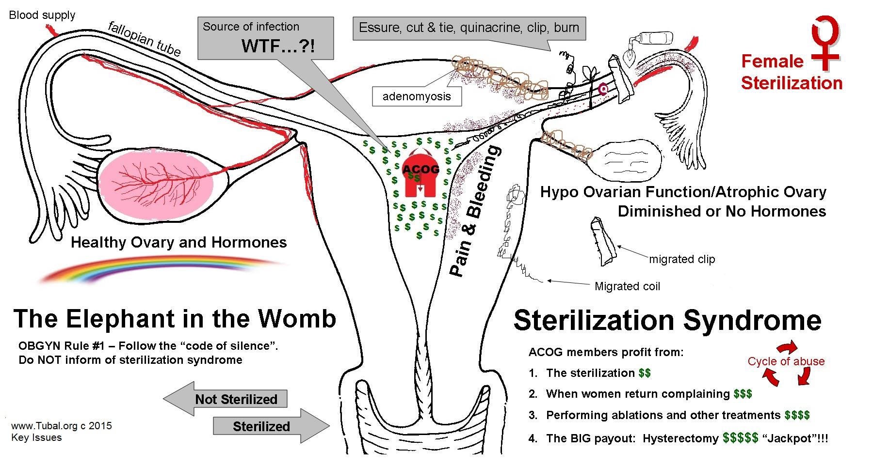 The Cycle of Abuse: Female Sterilization, Essure, Tubal 