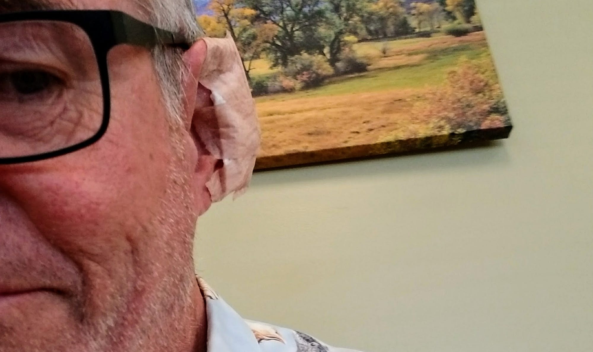 Mohs surgery on my ear John Records Medium