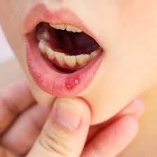 mouth ulcer in babies