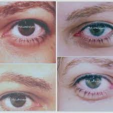 eye color changing surgery cosmetic