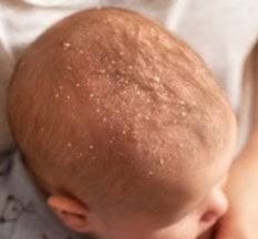 3 Main causes of cradle cap in babies, its symptoms and treatment