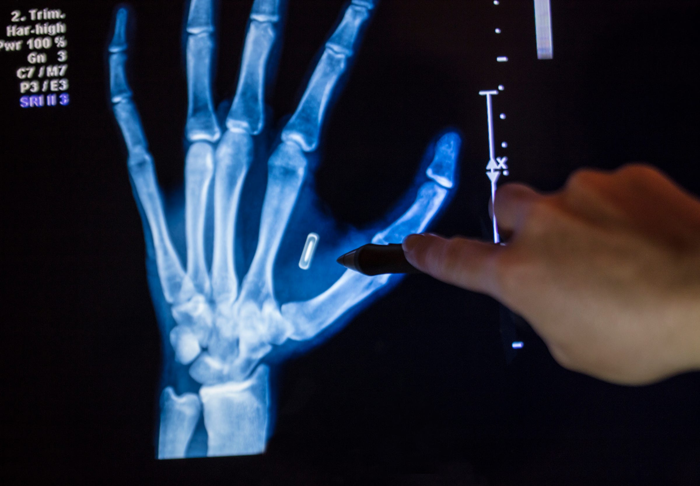 Why You’re Probably Getting a Microchip Implant Someday