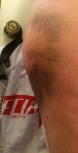 Hematoma, a few days before camp in March.