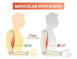 Muuscular Dystrophy