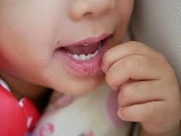 mouth ulcer in kids