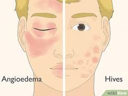 Hives and Angioedema