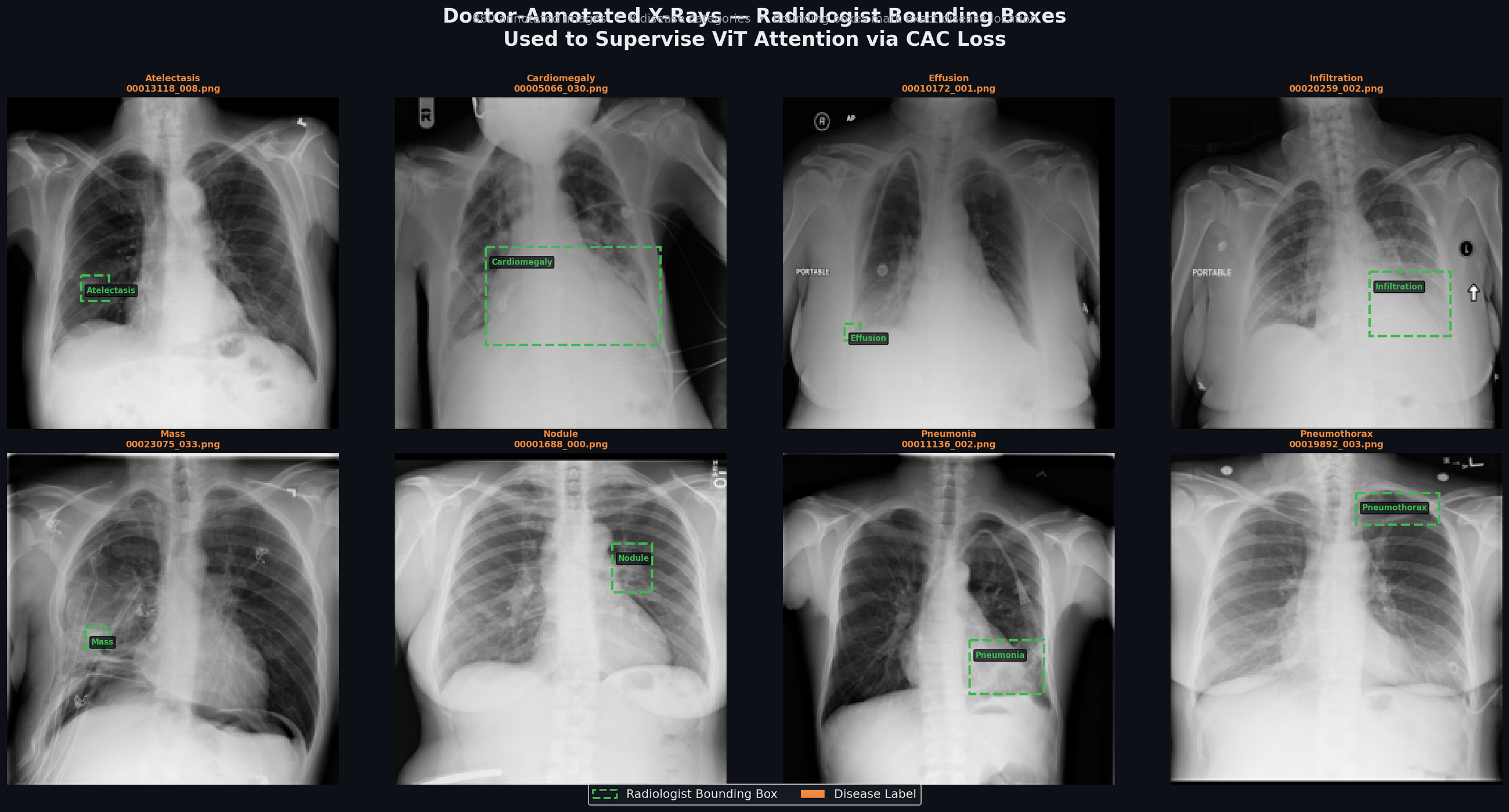 Teaching Machines to Read X-Rays the Way Radiologists Think: A Deep Dive into Vision Transformers…