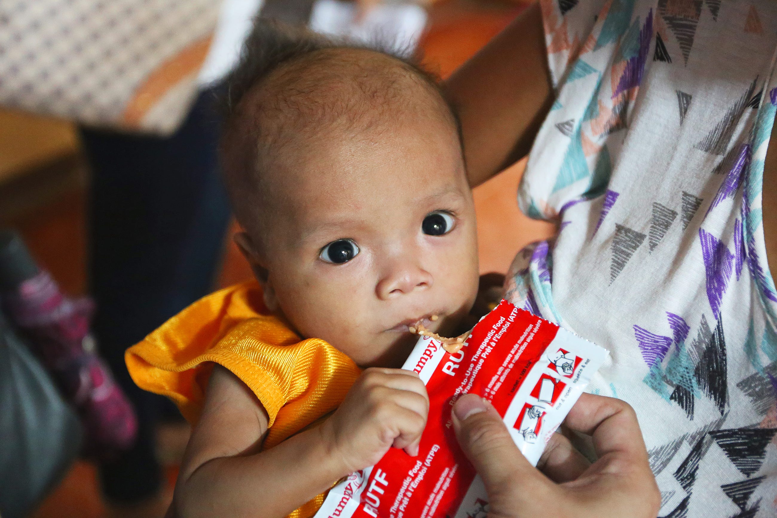 Treating Filipino children with severe malnutrition